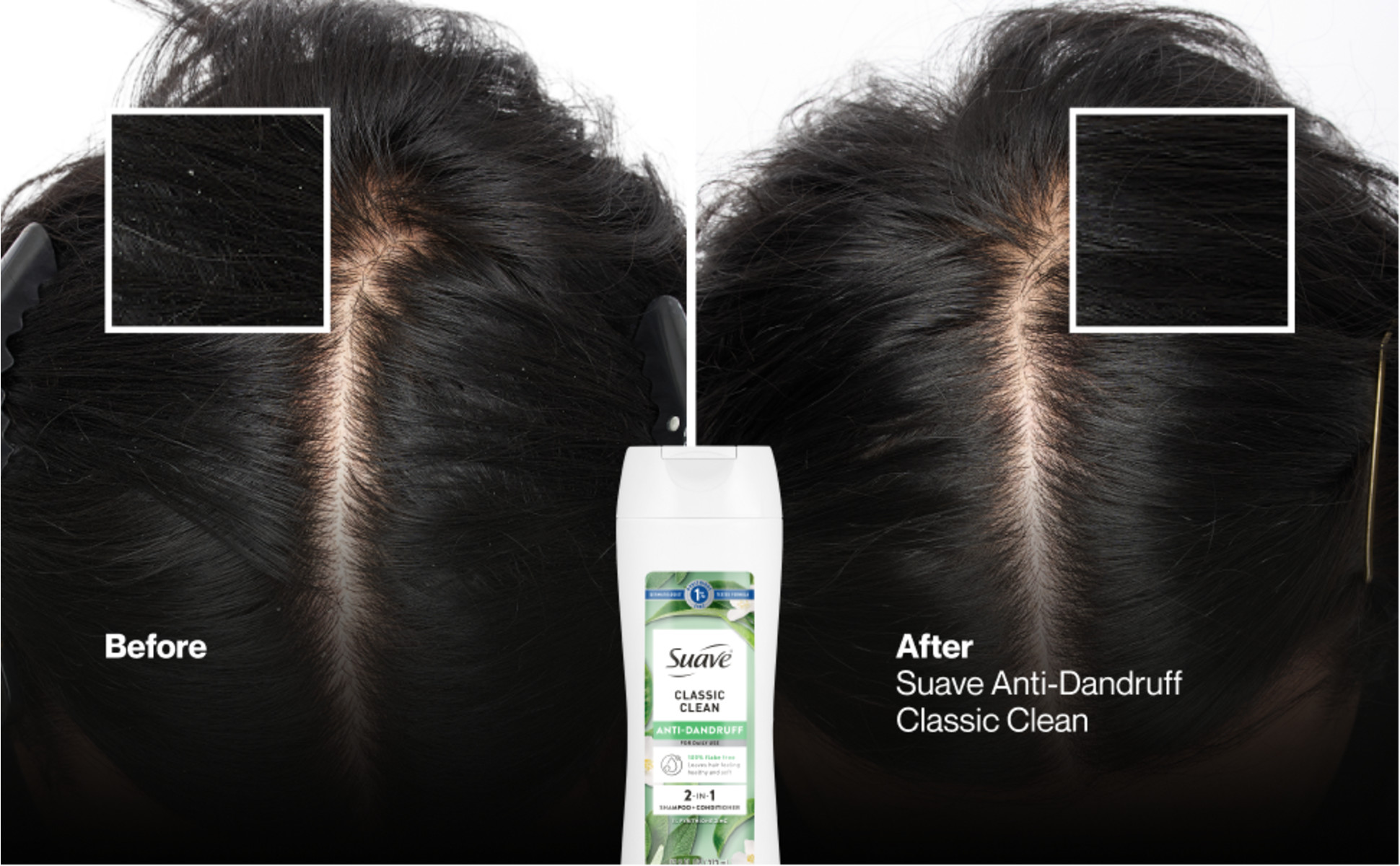 Before and After flakes in hair, dandruff free after Suave Anti-Dandruff Classic Clean